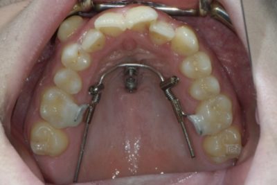 MiniPins Praxis Serbesis